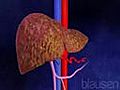 Liver Cirrosis | BahVideo.com