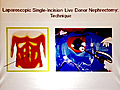 2011 UC Davis Nephrology and Transplantation  | BahVideo.com