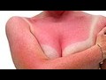 How to get quick sunburn relief | BahVideo.com