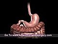 St Louis Sleeve Gastorectomy Dr Richard Follwell | BahVideo.com
