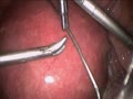 Cerclage In Pregnancy Laparoscopic HD | BahVideo.com