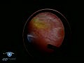 Vitrectomy For Retinal Detachment VR1 Basic Techni | BahVideo.com