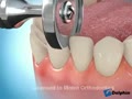 Dental Braces Animation | BahVideo.com