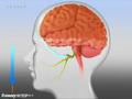 Migraine Treatment | BahVideo.com