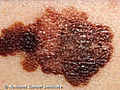 Track a Skin Mole for Melanoma | BahVideo.com