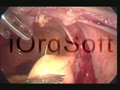Laparoscopic Uterosacral Colpoplexy HD | BahVideo.com