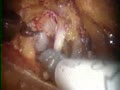 Robotic Prostatectomy Surgery HD | BahVideo.com