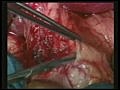Gallbladder Cancer Resection | BahVideo.com