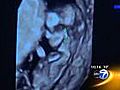 3D ear imaging may predict fetus problems | BahVideo.com