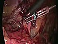 Laparoscopic inguinal hernia repair HD | BahVideo.com