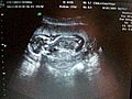 Pregnant pic s and Ultrasounds video 027 | BahVideo.com
