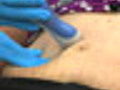 Laser Treatment for Stretch Marks | BahVideo.com