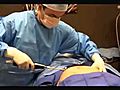 Liposuction with Tickle Lipo at Celebrity  | BahVideo.com