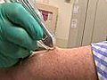 New Tool to Diagnose Melanoma | BahVideo.com
