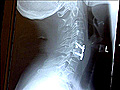 Innovations in Spine Care | BahVideo.com