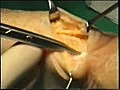 Hand Surgery on De Quervain s Disease Patient | BahVideo.com