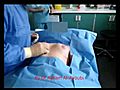 Macrolane - Buttocks Enhancement by Dr Ayham Al-Ayoubi HD | BahVideo.com