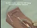 Intra-Uterine Device IUD Insertion | BahVideo.com