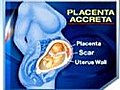 Placenta Accreta Dangers of Multiple C-Sections | BahVideo.com