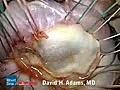 Mitral Valve Repair of Posterior Leaflet Prolapse HD | BahVideo.com