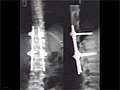 Recurrent Spinal Deformity Above Spinal Fusion | BahVideo.com