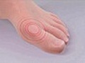 Gout a debilitating form of arthritis | BahVideo.com