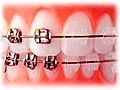 Ortodontik tedavi ne kadar s rer  | BahVideo.com