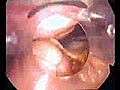 Laparoscopic Appendectomy | BahVideo.com