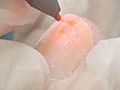 Technology can zap away toe fungus | BahVideo.com