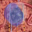 Nanoknife Cancer Surgery | BahVideo.com