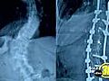 traightening Spines Shortening Recoveries | BahVideo.com