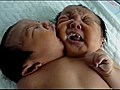 Naissance d un enfant bic phale en Chine | BahVideo.com