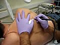 Mole Removal Cosmetic Radiosurgery | BahVideo.com