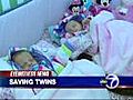 Unborn twins face life-threatening abnormality | BahVideo.com