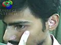 Vitiligo Cure | BahVideo.com
