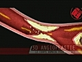 Observez de pr s une angioplastie | BahVideo.com