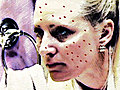 Natural Cures Acne | BahVideo.com