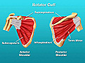Shoulder Surgery Rotator Cuff | BahVideo.com