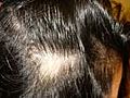 La p rdida de pelo debido a la alopecia | BahVideo.com