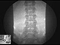 Low Back Pain Spinal Decompression Vancouver  | BahVideo.com