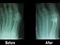 Bunions - Podiatrist in Cherry Hill Voorhees  | BahVideo.com