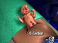 Pre-birth surgery saves baby s life | BahVideo.com
