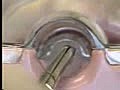 Intra-Uterine Device IUD Removal | BahVideo.com
