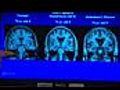 Imaging Dementia | BahVideo.com