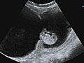  amp 039 No foetal pain amp 039 before 24 weeks | BahVideo.com