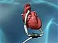 Permanent heart pump aids survival | BahVideo.com