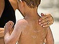 How to protect your child from sunburn | BahVideo.com