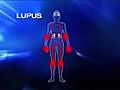 Revolutionary drug to fight lupus | BahVideo.com