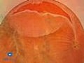 Giant Retinal Tears VR1 Basic Techniques | BahVideo.com