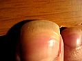 long toenails 2 | BahVideo.com
